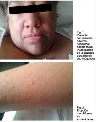 DRESS: Sindrome de hipersensibilidad a la Dapsona – PIEL-L Latinoamericana