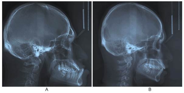 Pituitary Gigantism Skeleton