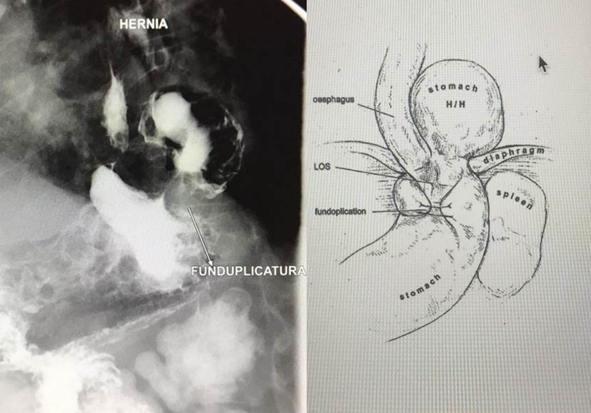 Recidiva Paraesofágica De Hernia Hiatal. Diagnóstico Radiológico Y ...