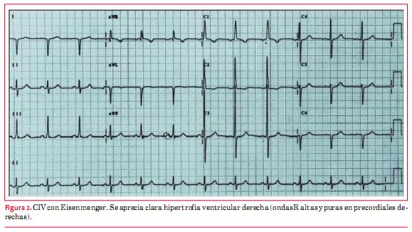 Hvi Ecg Hipertrofia Ventricular Derecha En El Electrocardiograma An